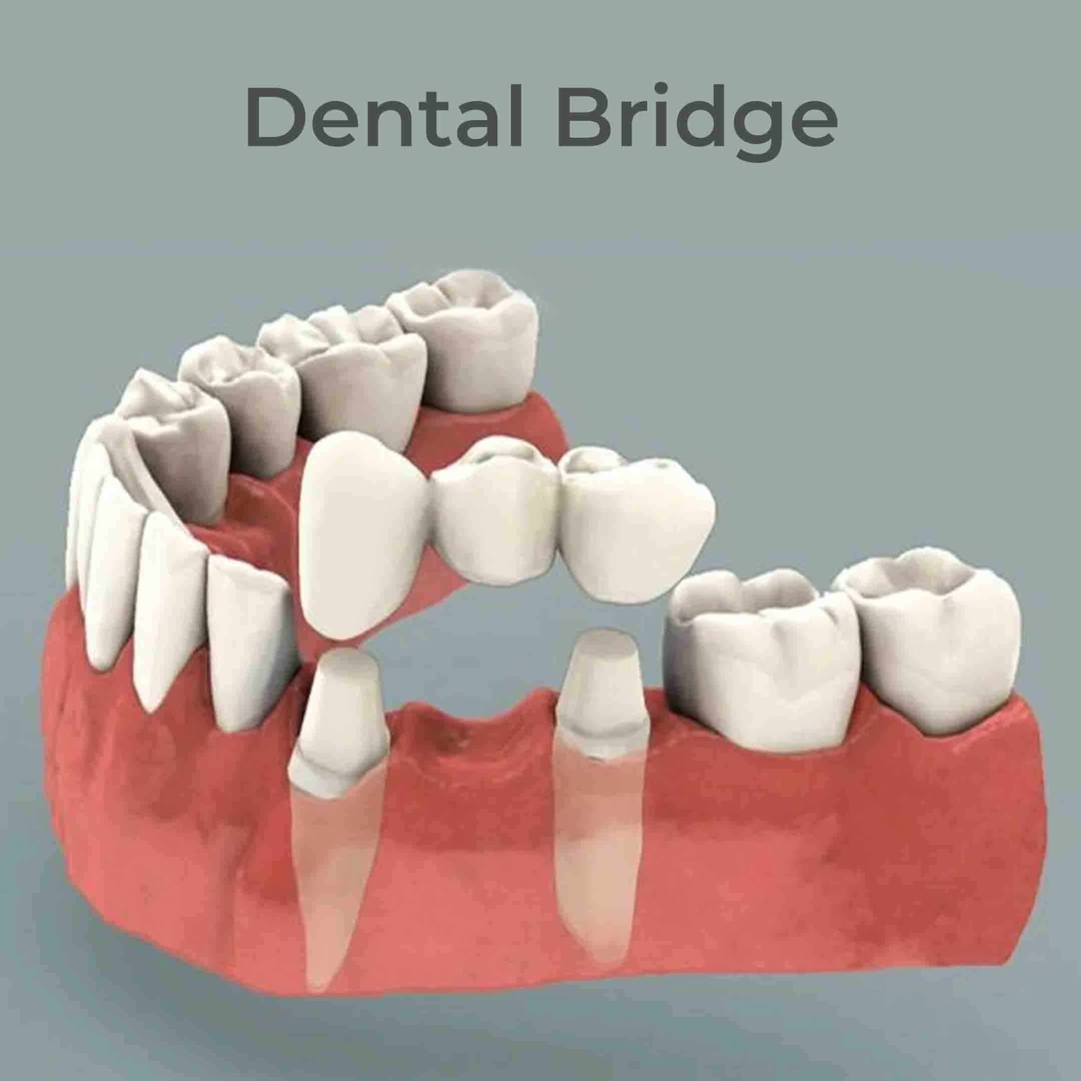 Dental Bridges