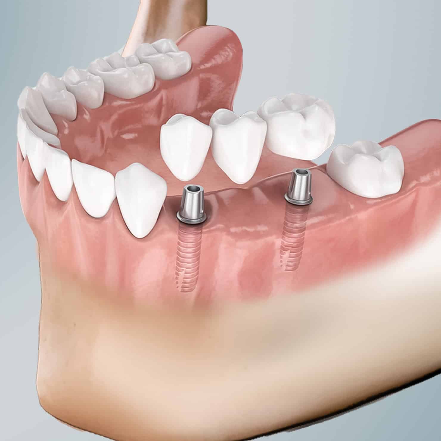 Dental Implants