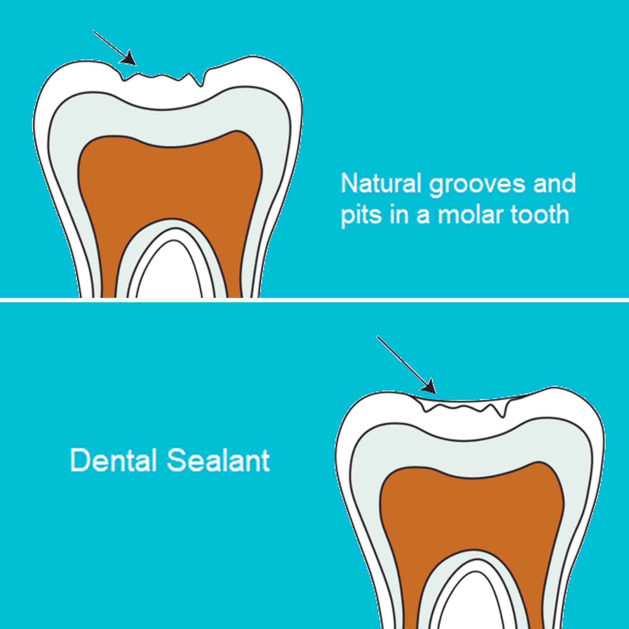 Dental Sealants for Kids