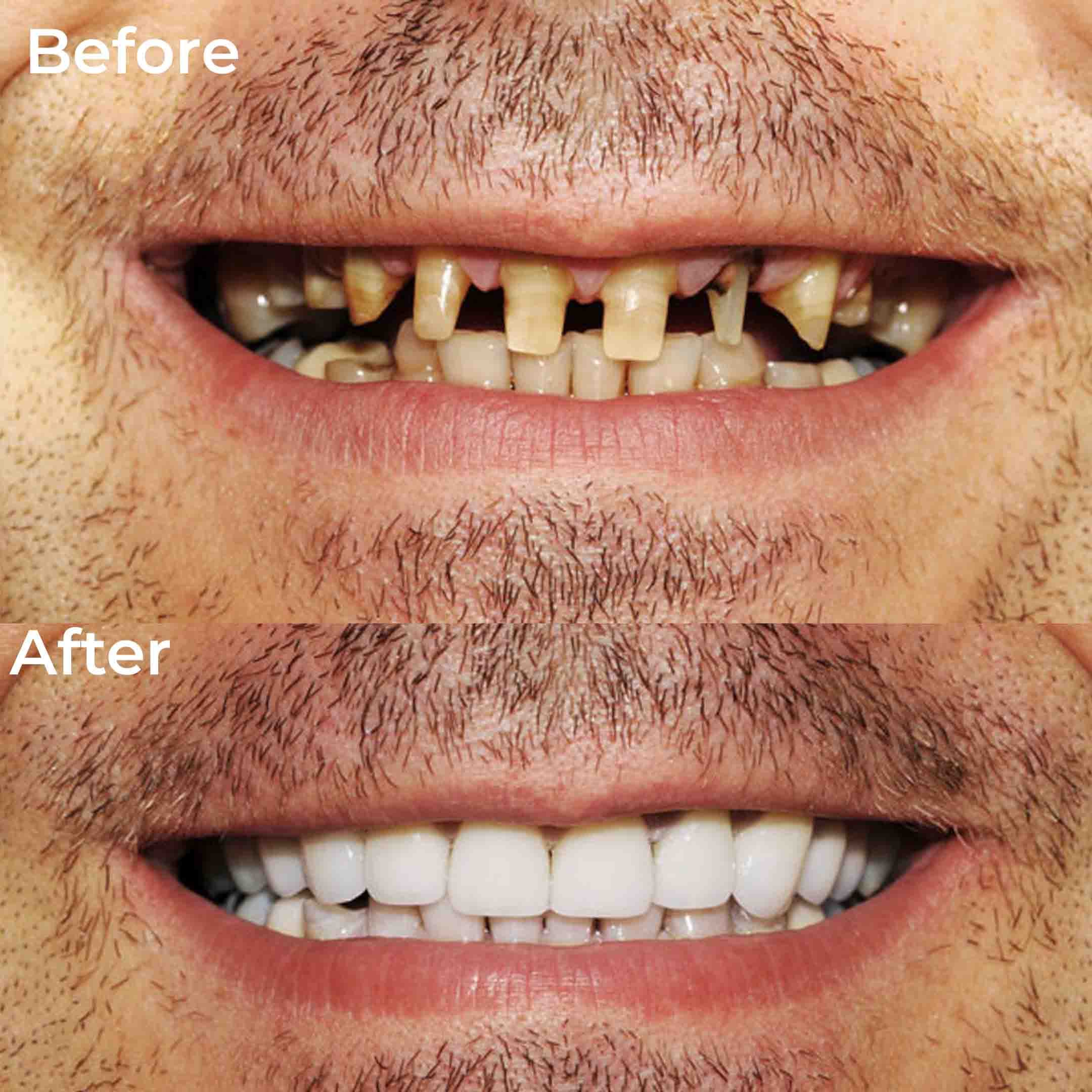 Dental Veneers before and after