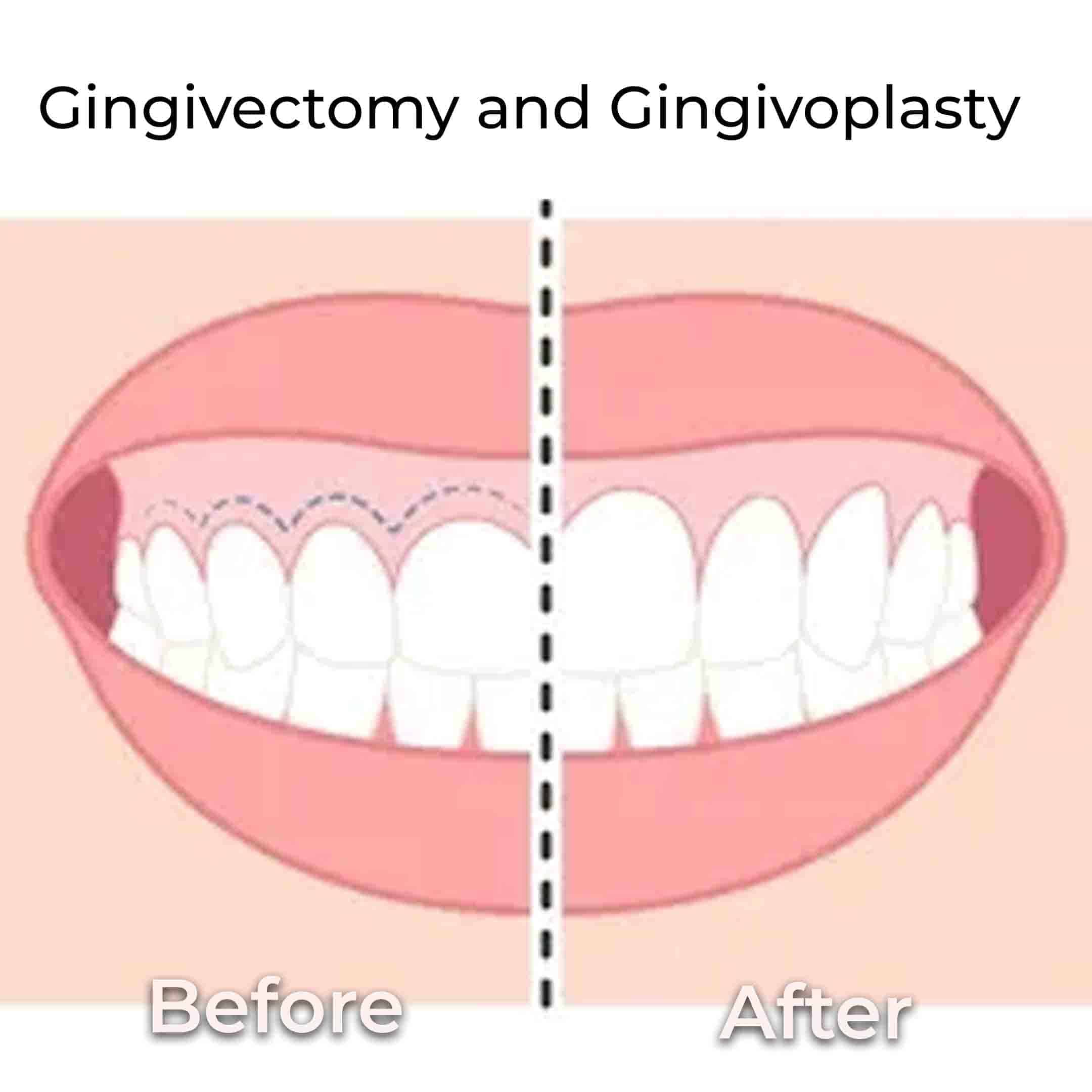 gingivectomy vs Gingivoplasty