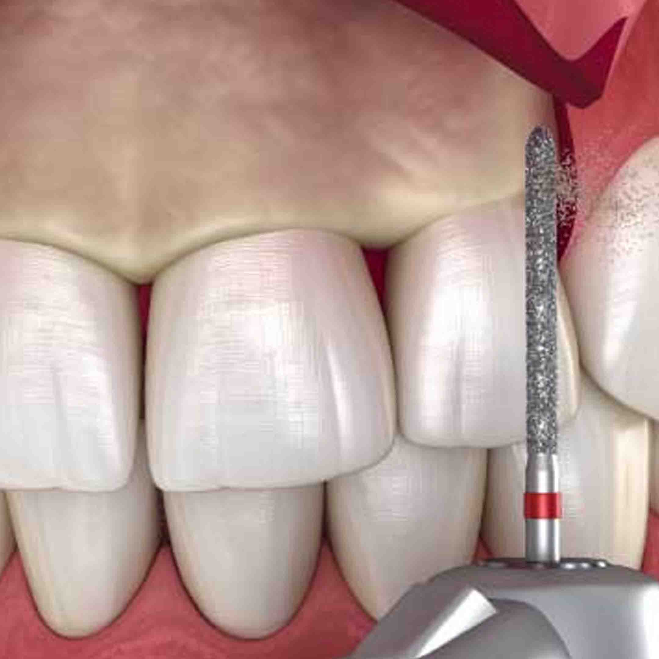 Gummy Smile/Lip Repositioning Surgery