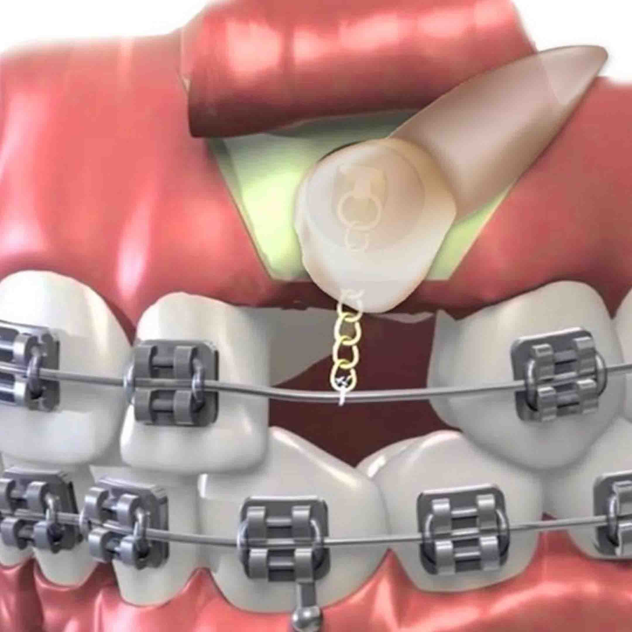 What Does an Impacted Tooth Look Like