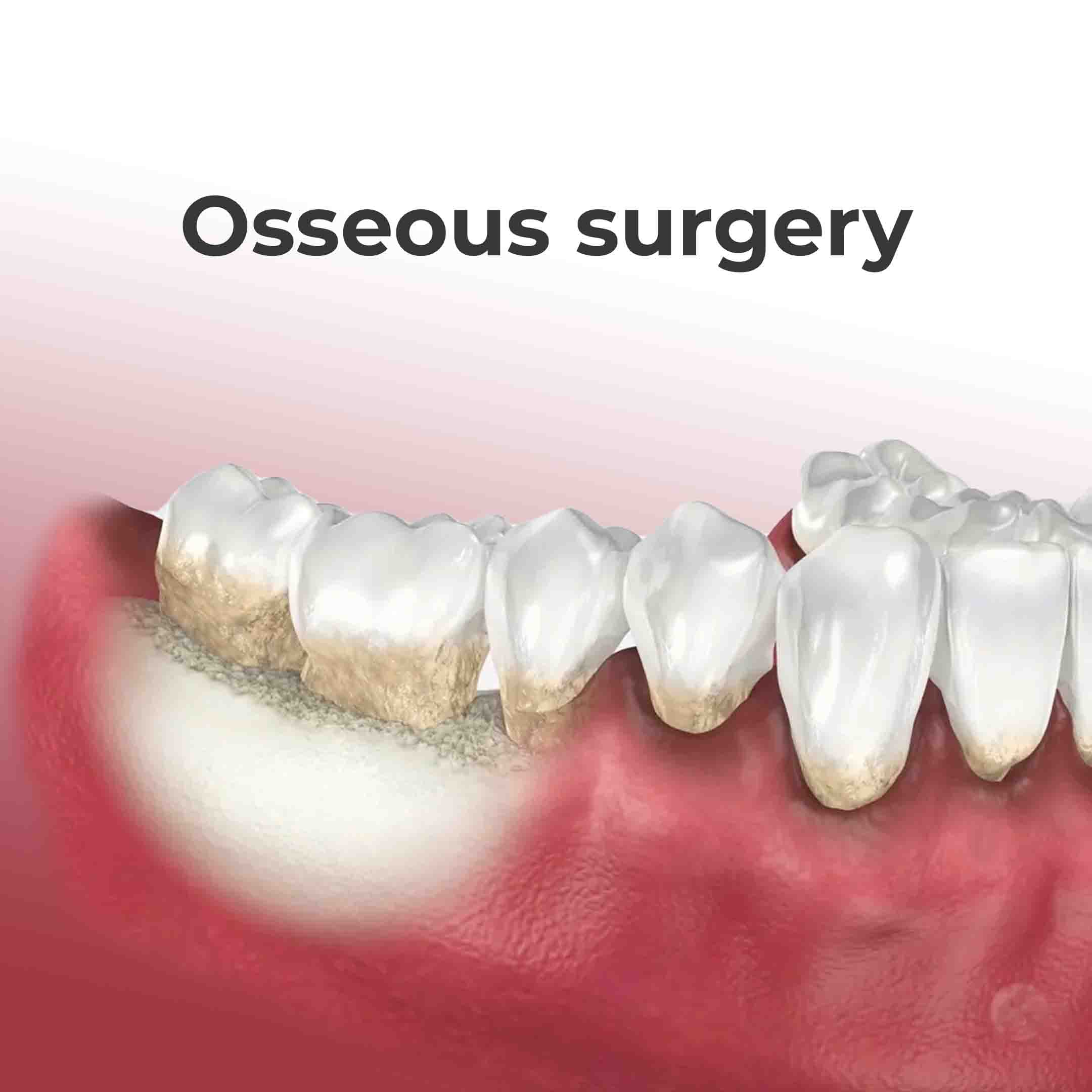 osseous surgery