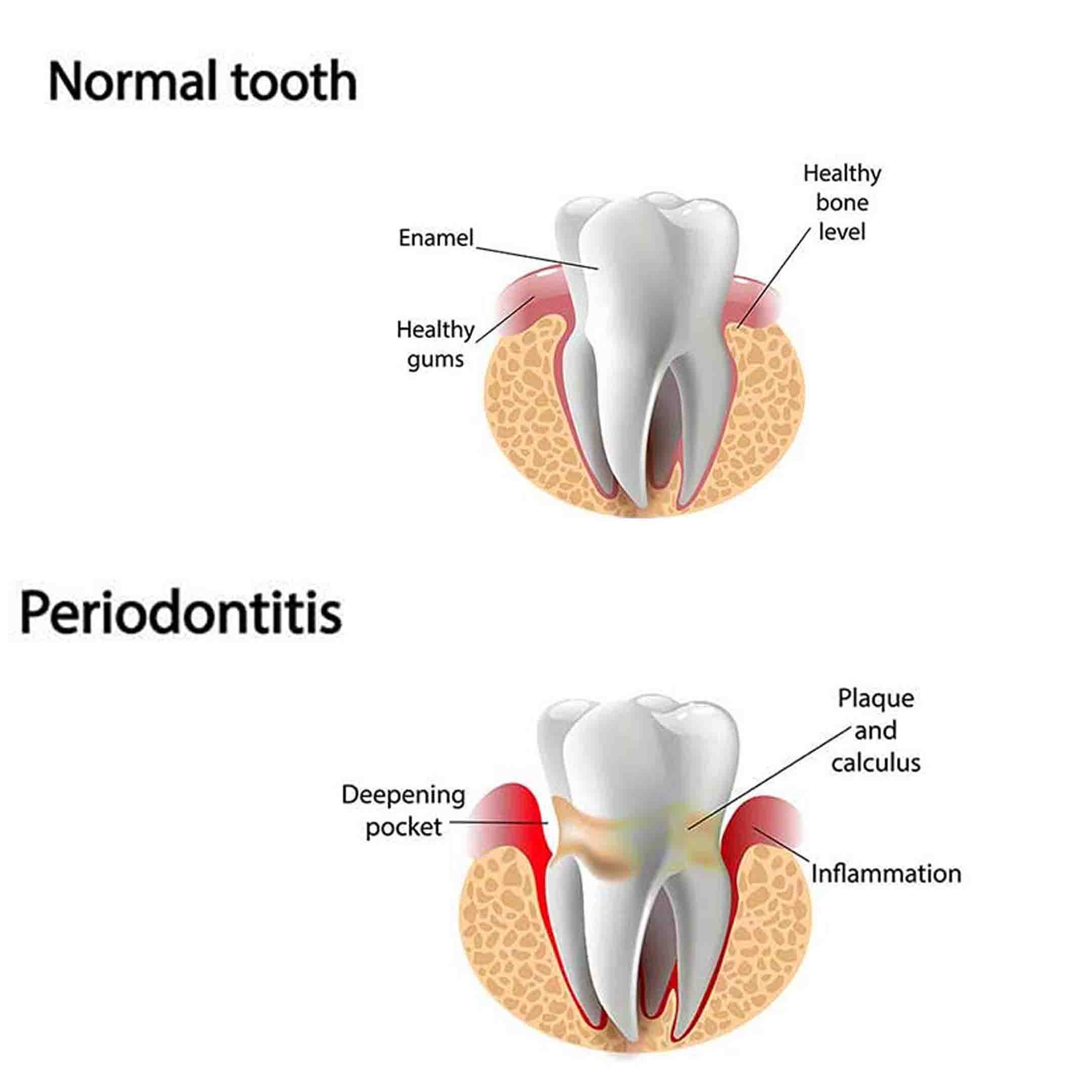 periodontal maintenance after deep cleaning