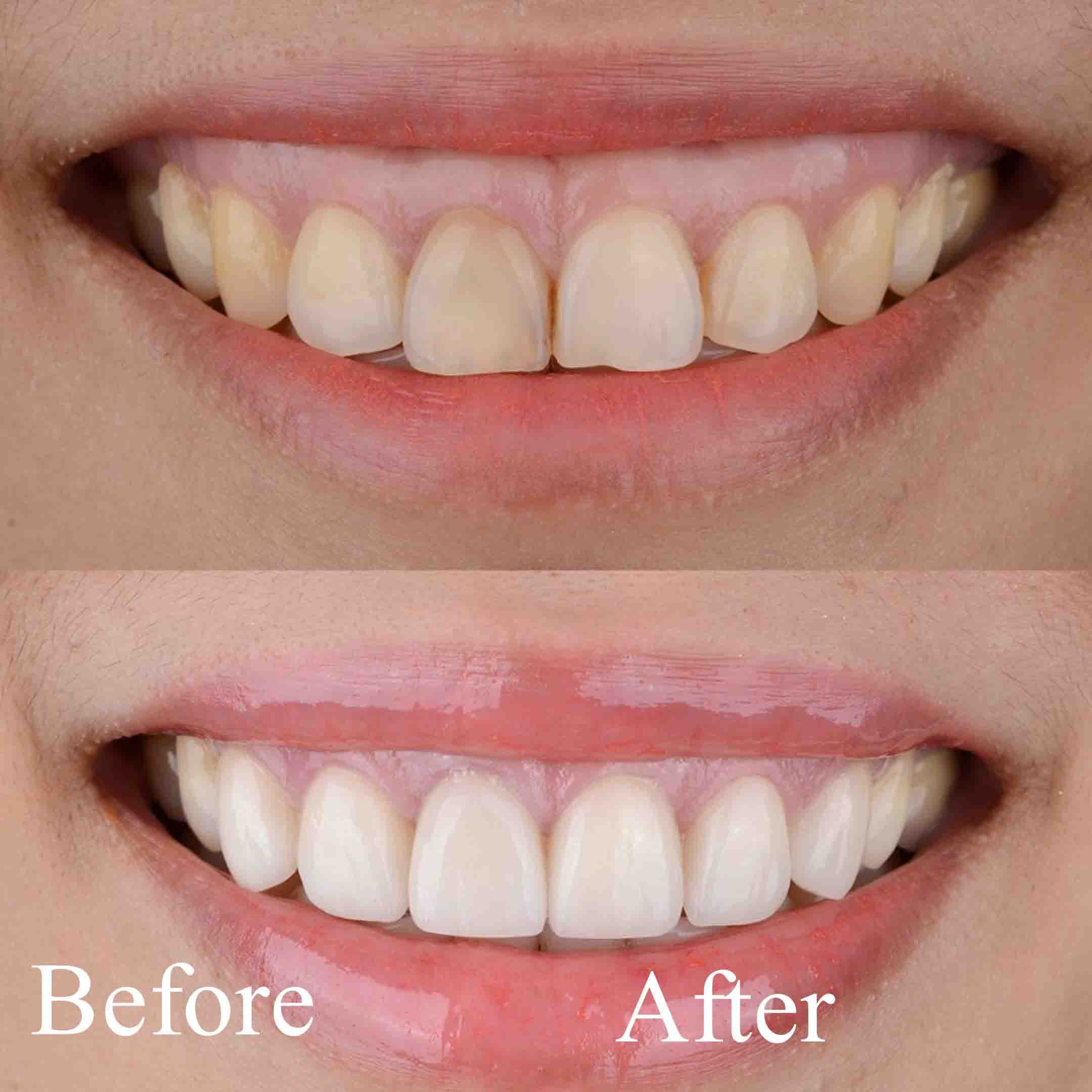 pinhole gum surgery before and after