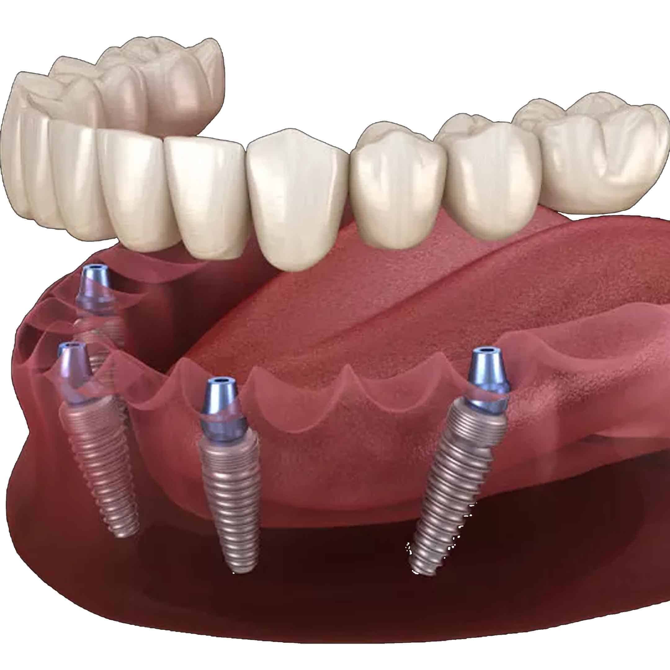 Purpose of Full-Arch Restoration