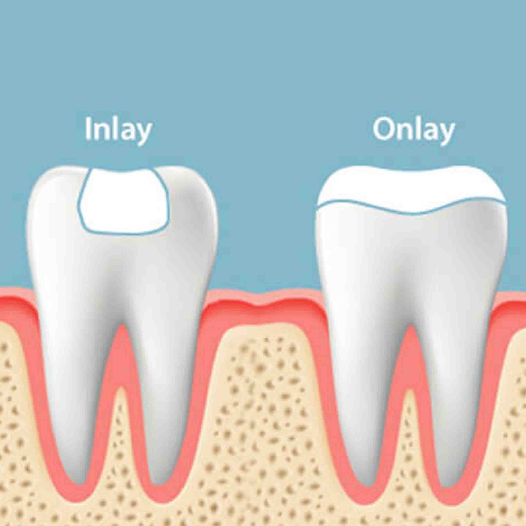 teeth inlays and onlays