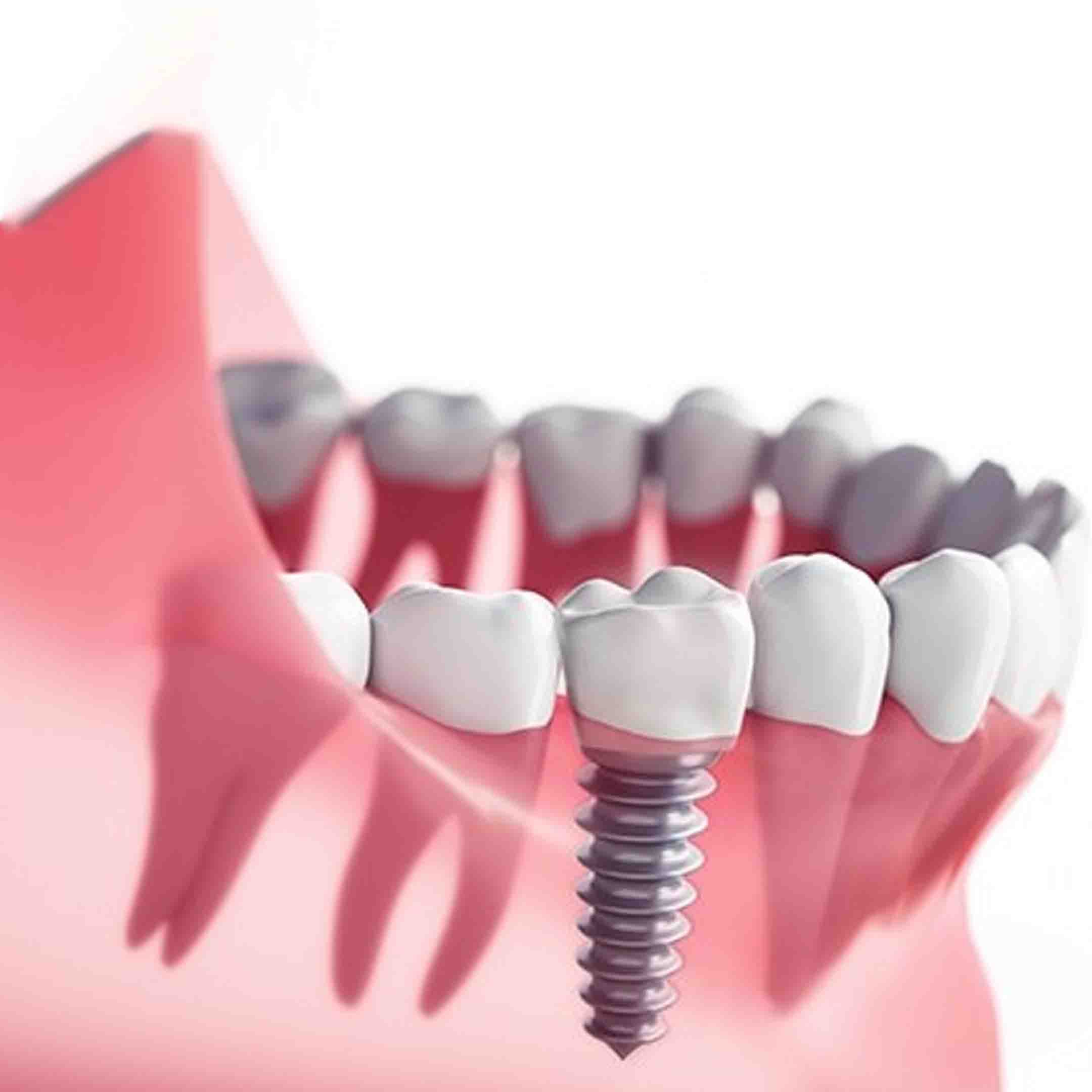 Tooth Implant Diagram