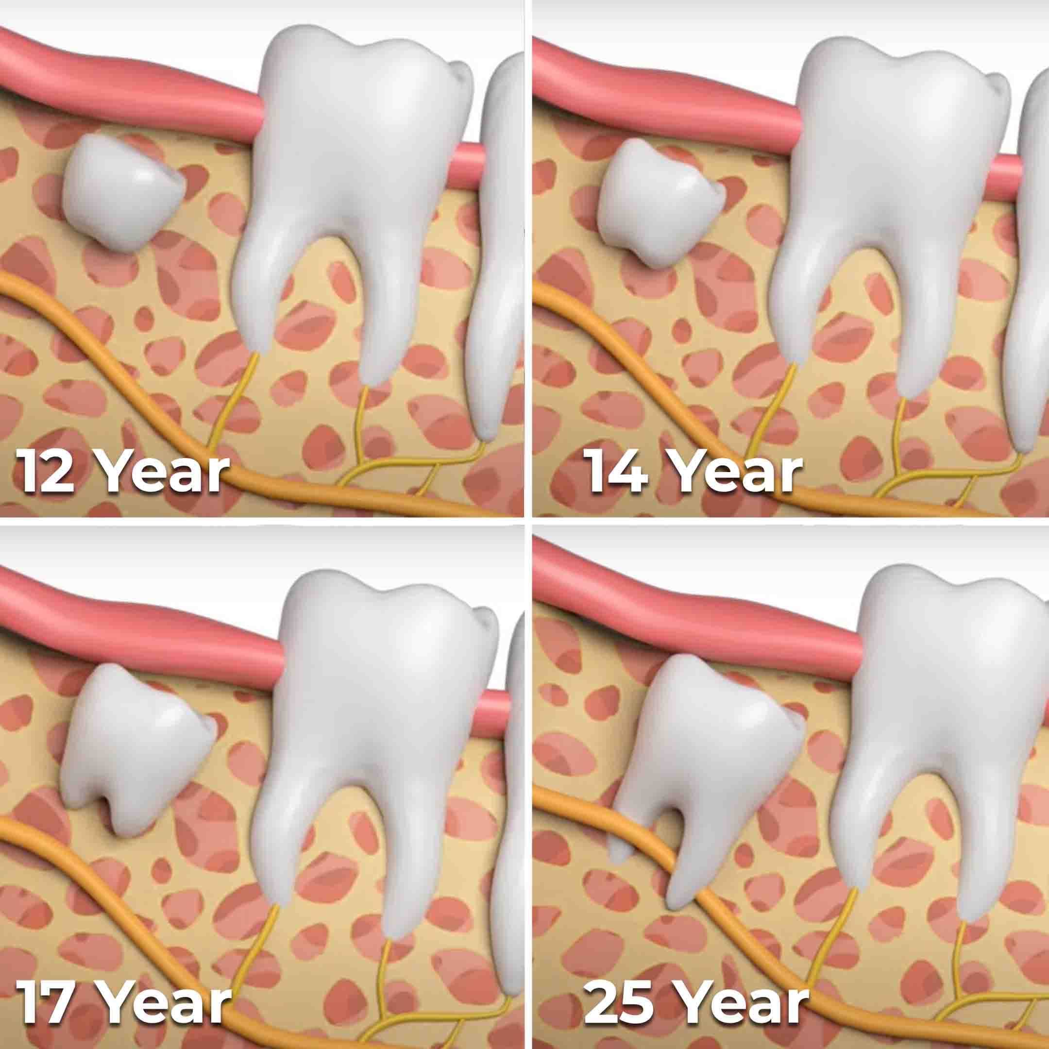 age to remove wisdom teeth