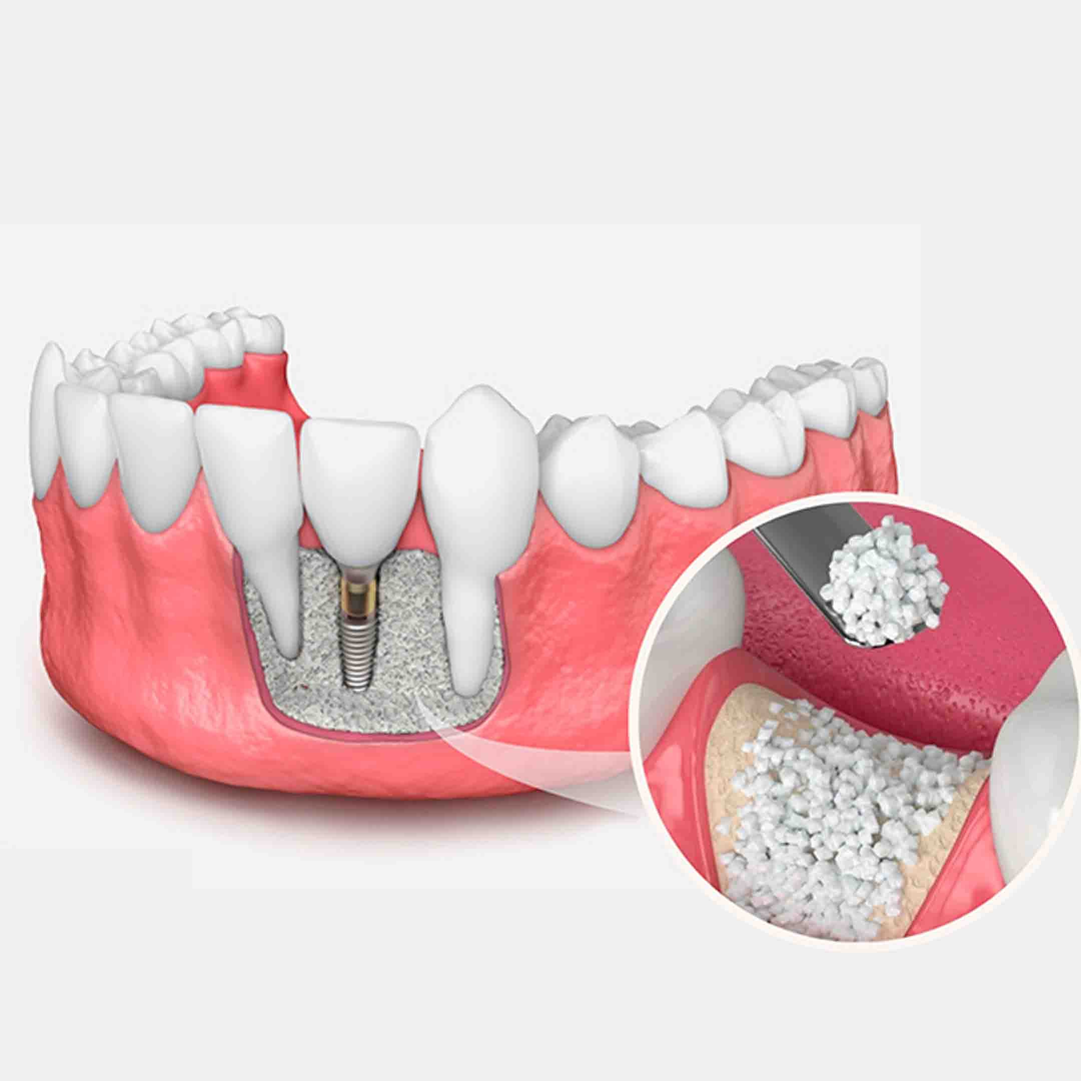 bone grafting in Fresno, CA