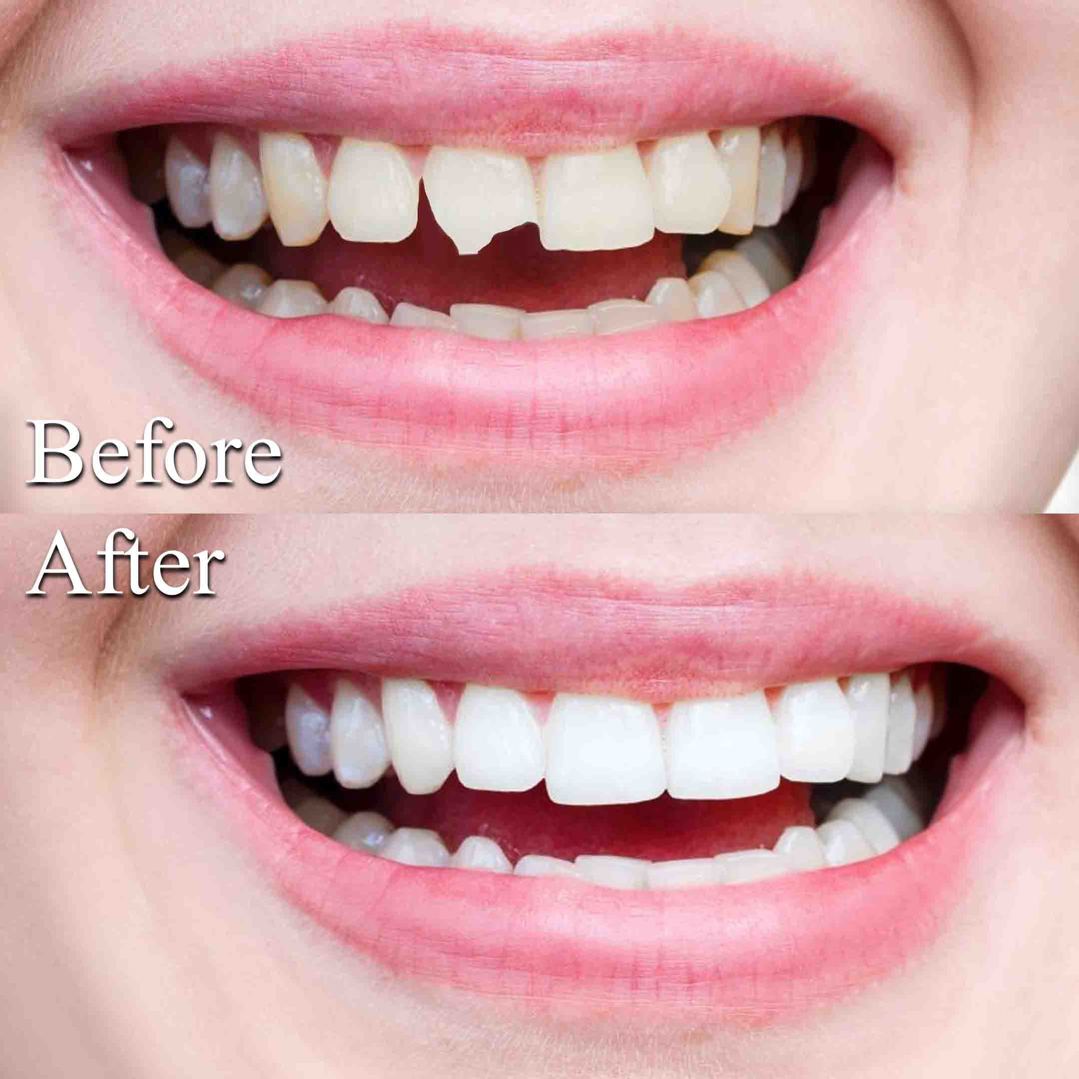 dental crowns before and after