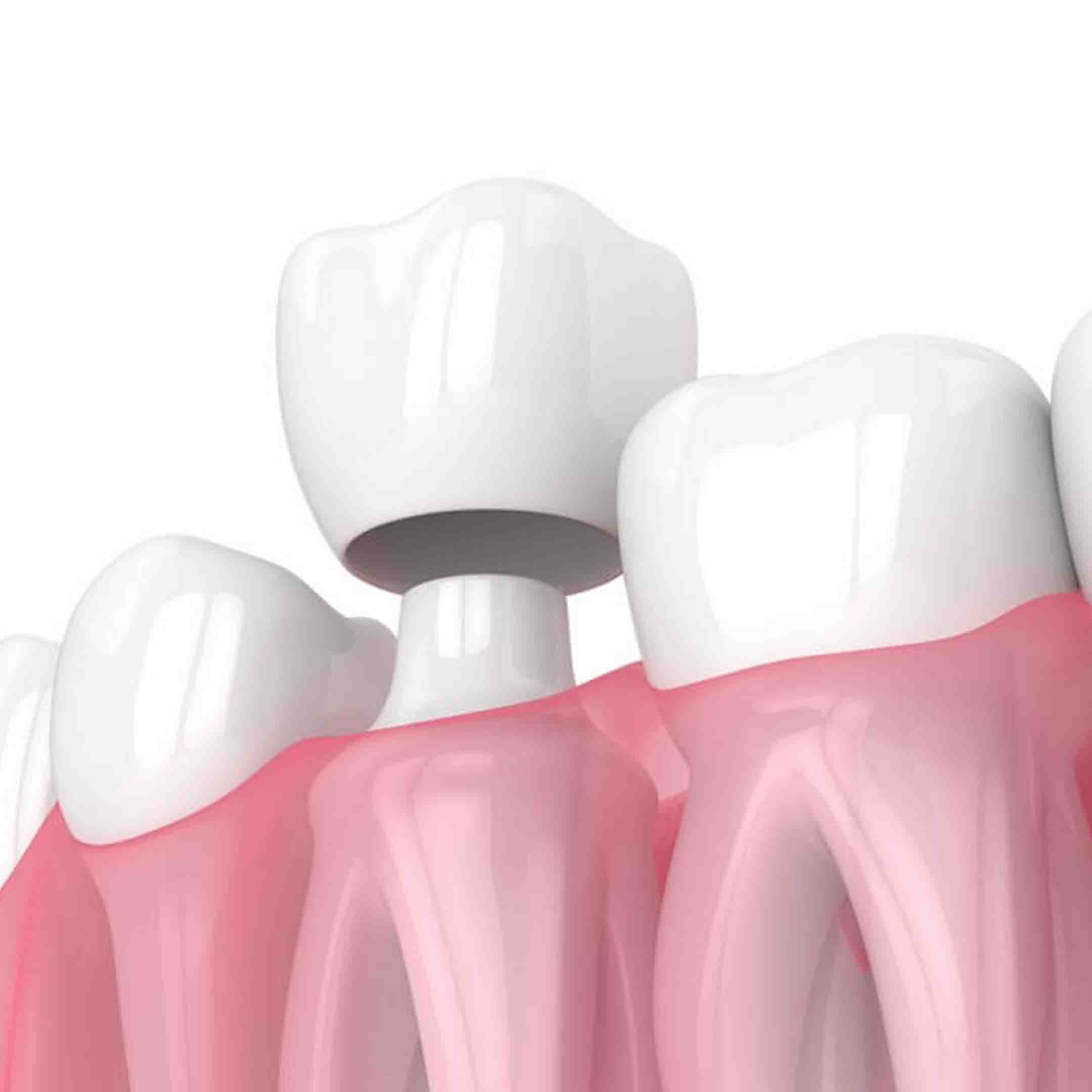 Dental Crowns