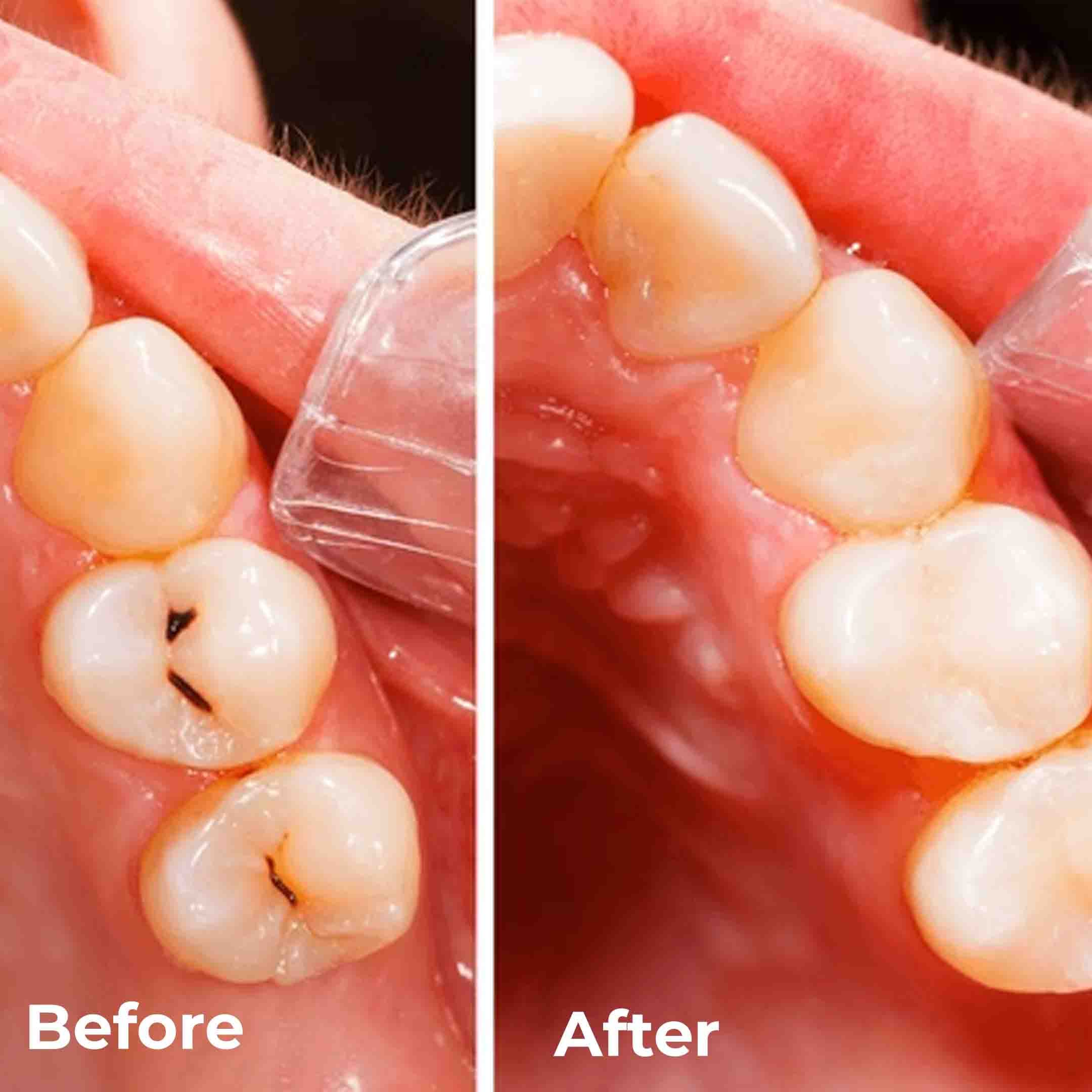 dental filling images before and after