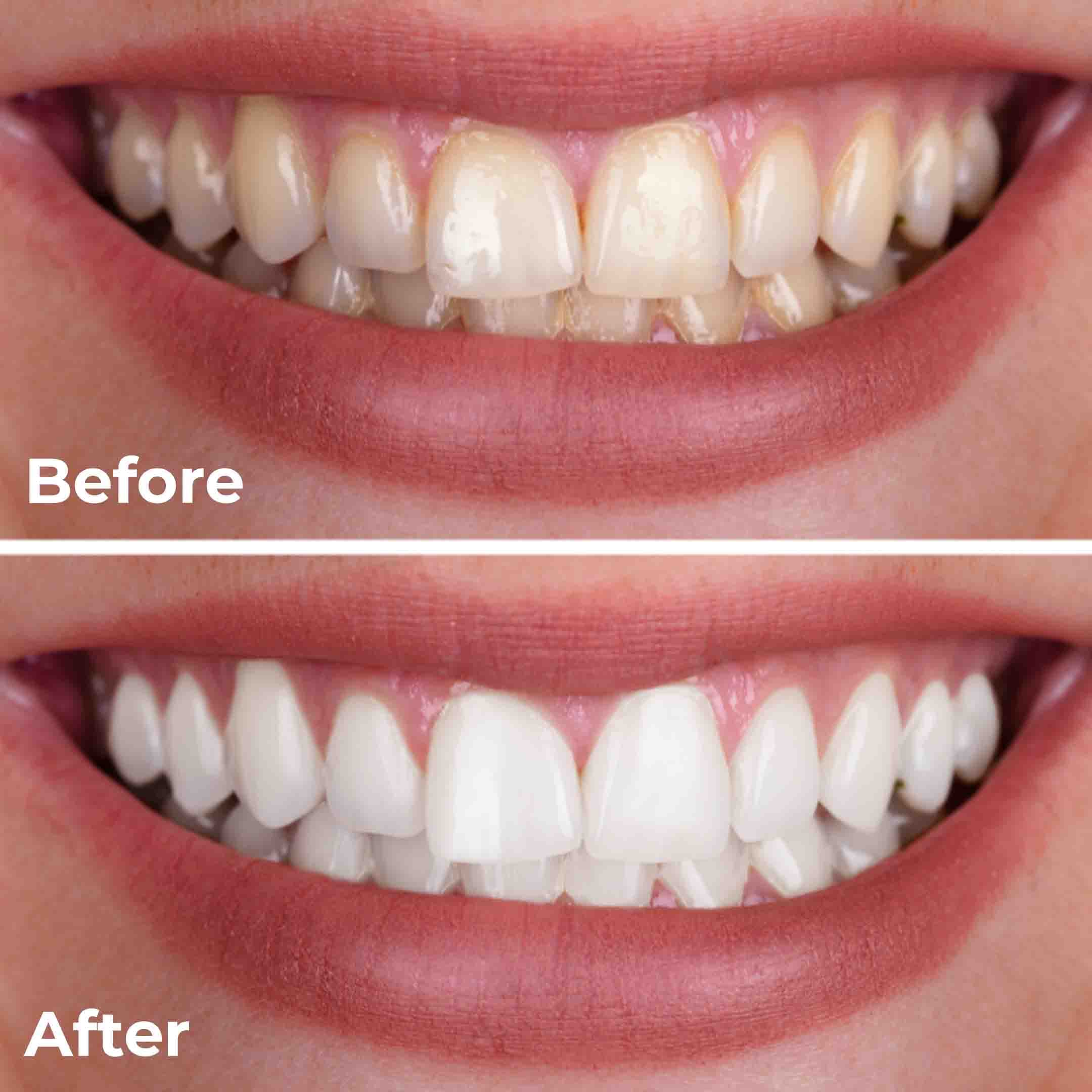 fluoride treatment before and after