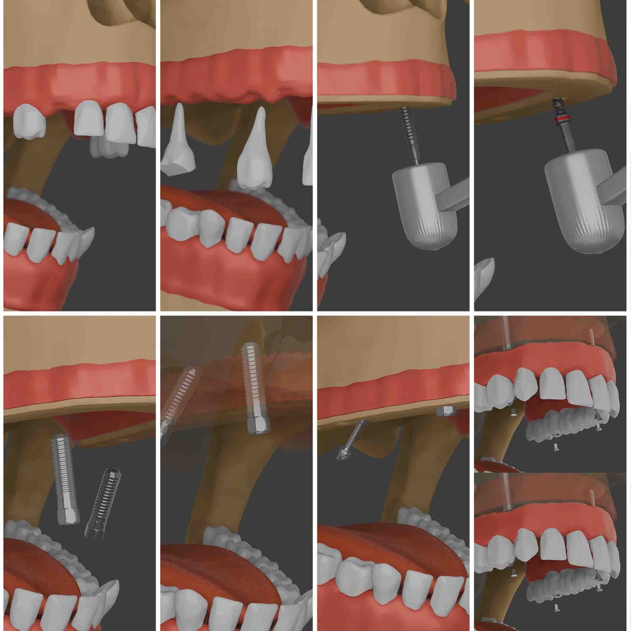 Step by step procedure of full arch restoration