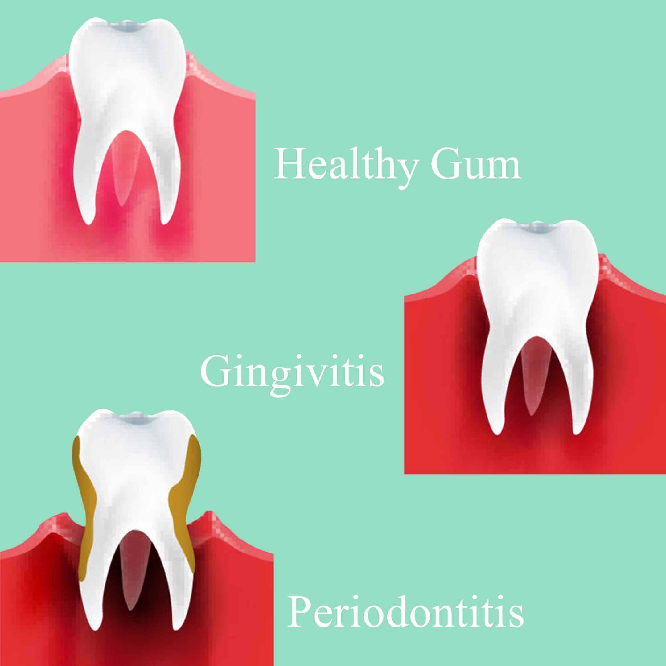 gum infection causes