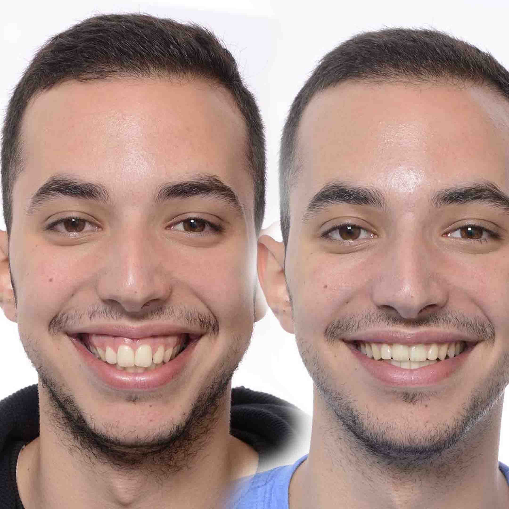 gummy smile before and after