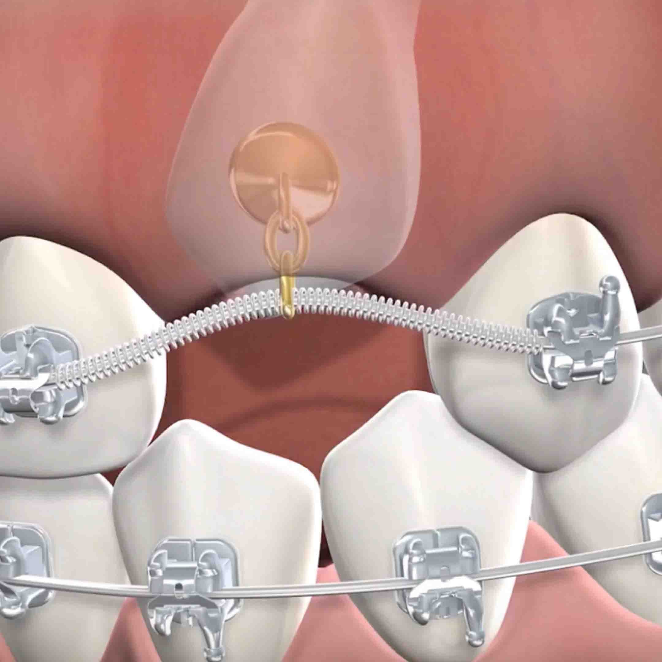 impacted canine tooth extraction