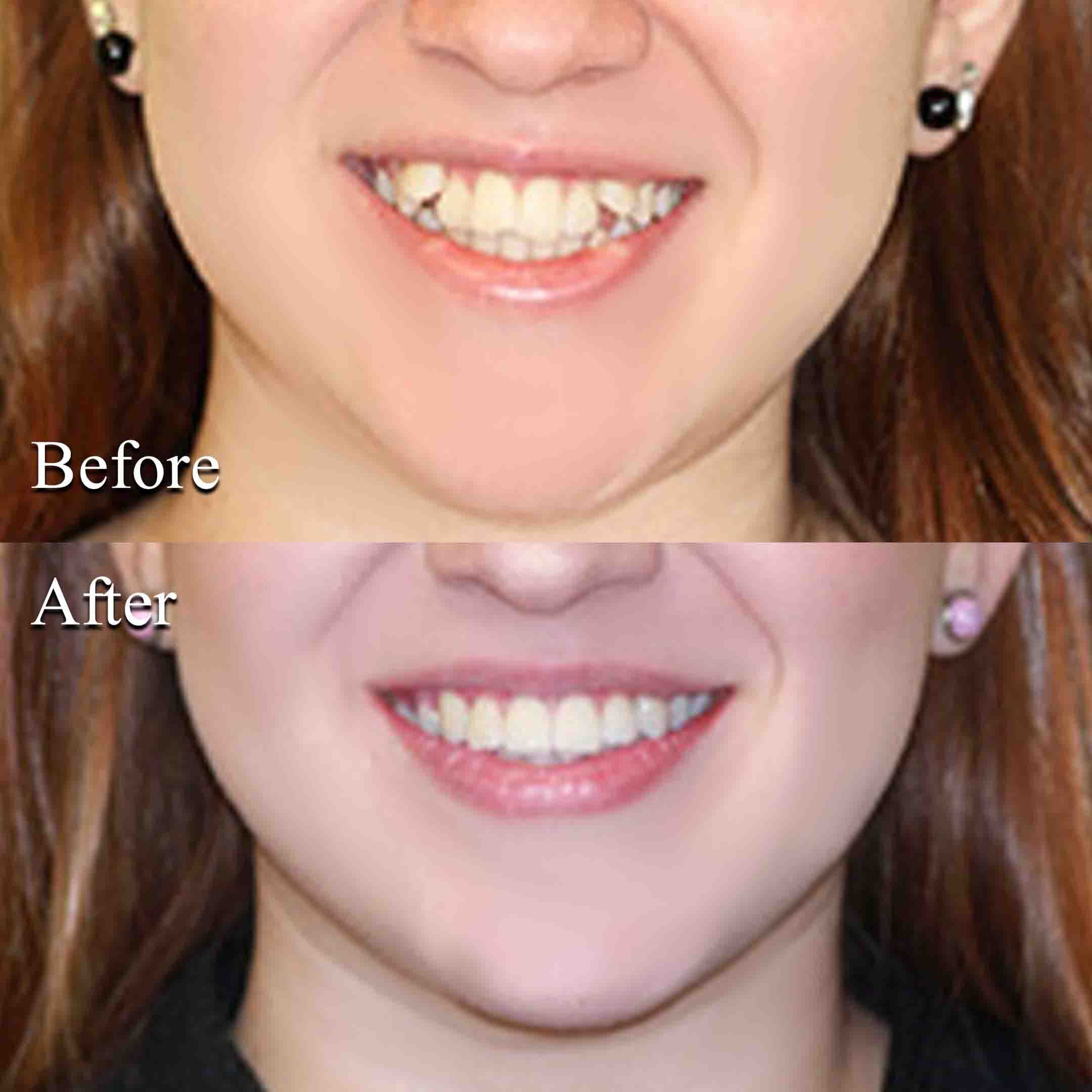 before and after impacted canine tooth braces