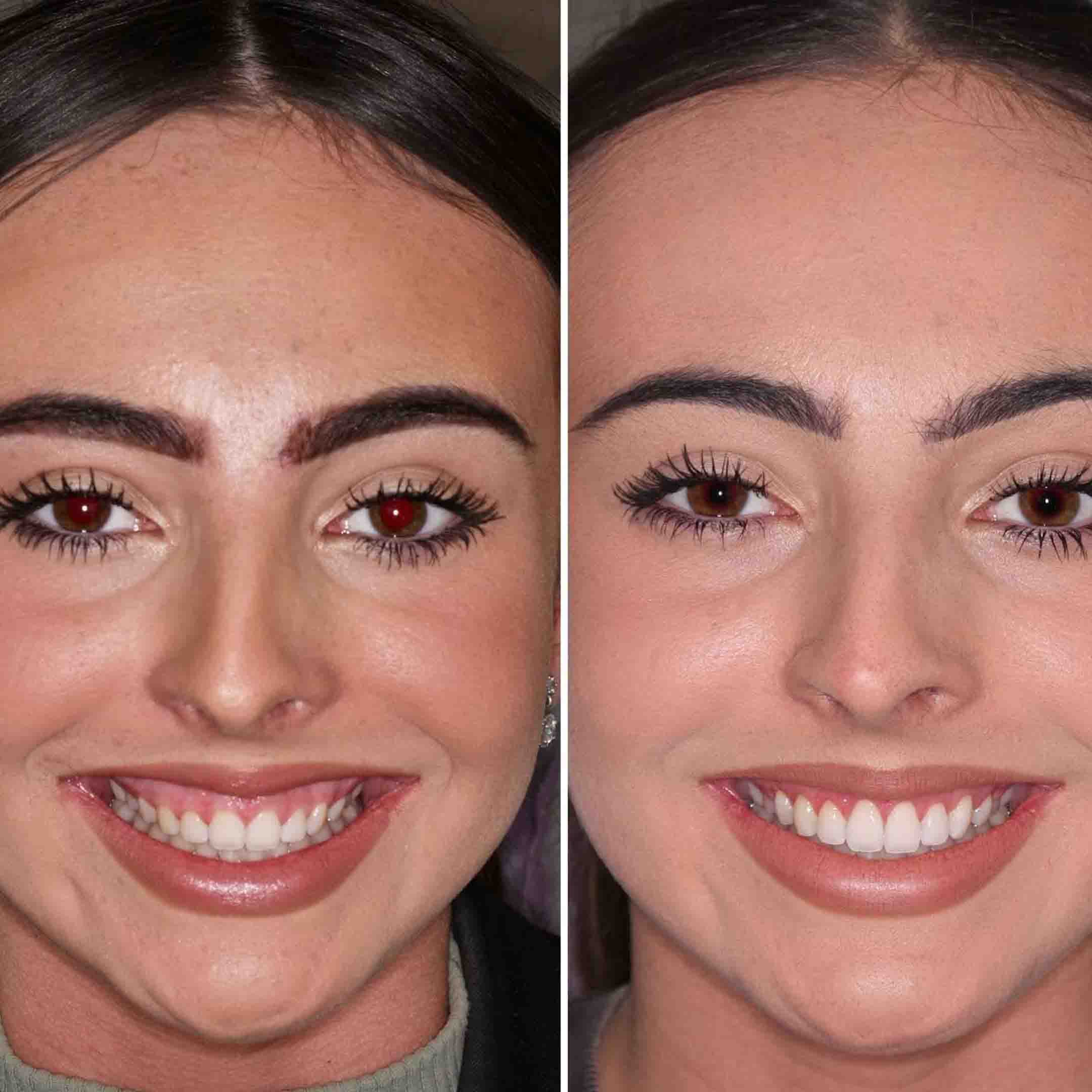 how much does a gummy smile surgery cost