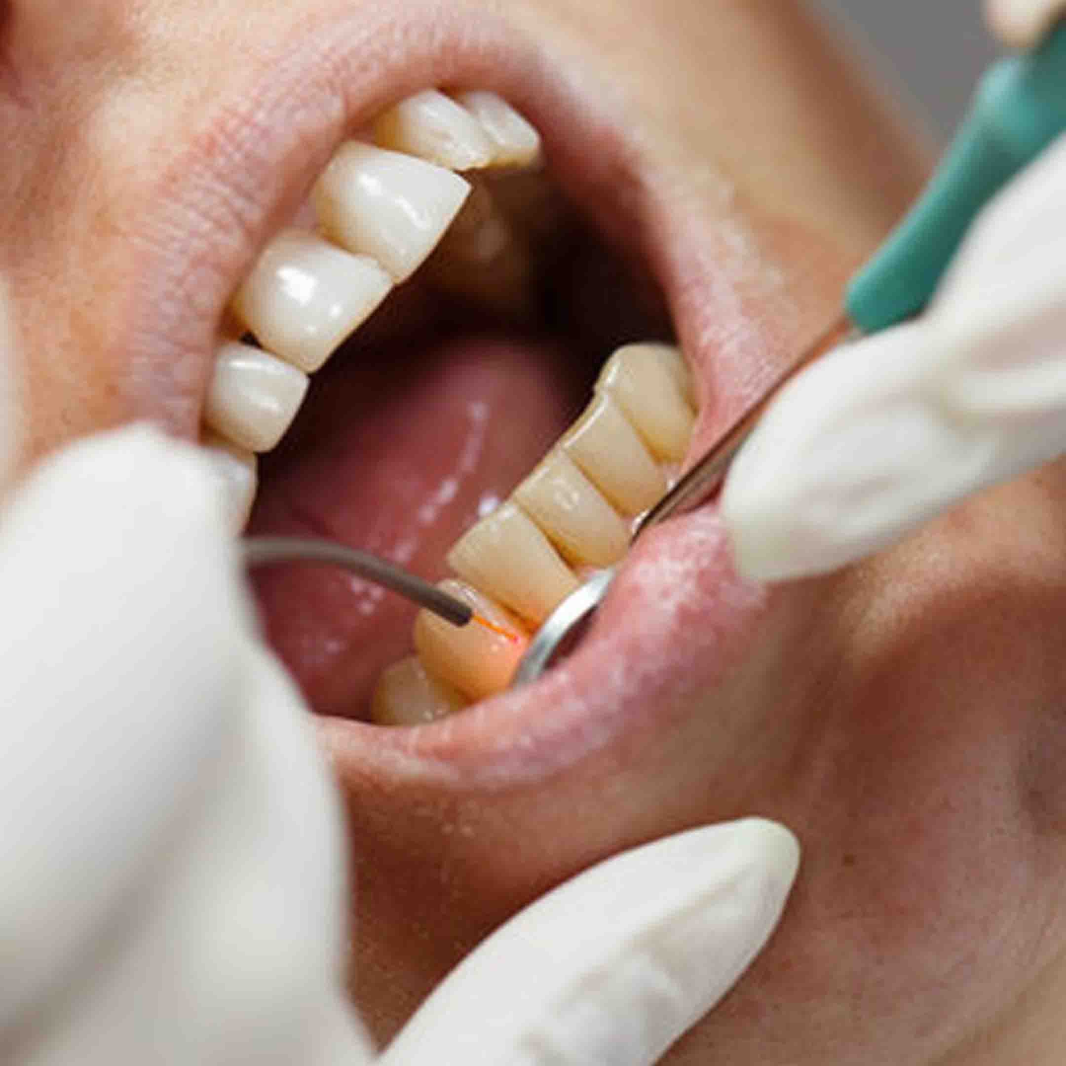 Laser Periodontal Gum Disease Treatment