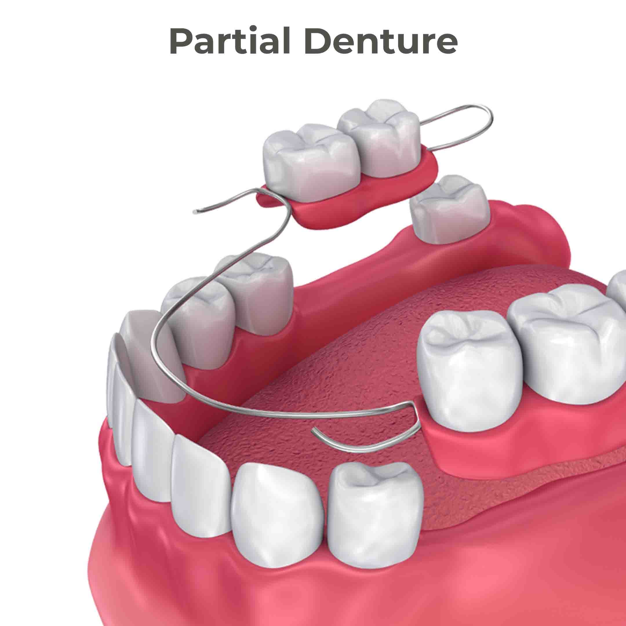 Partial Dentures