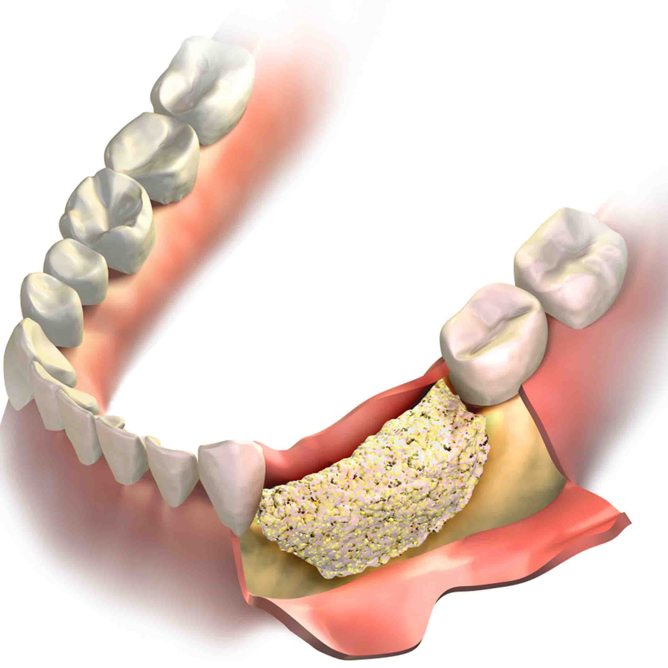 periodontal bone graft