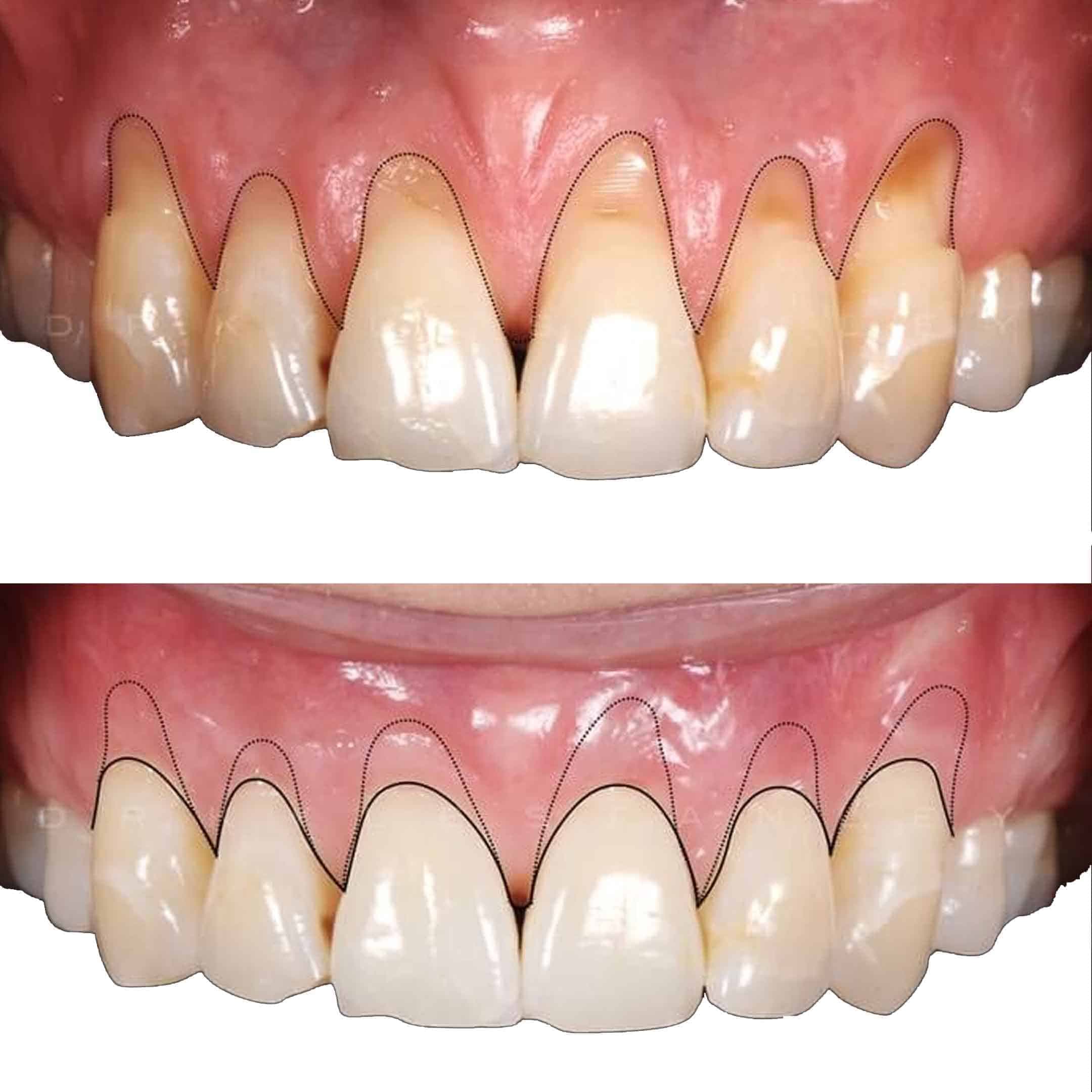 pinhole procedure for receding gums