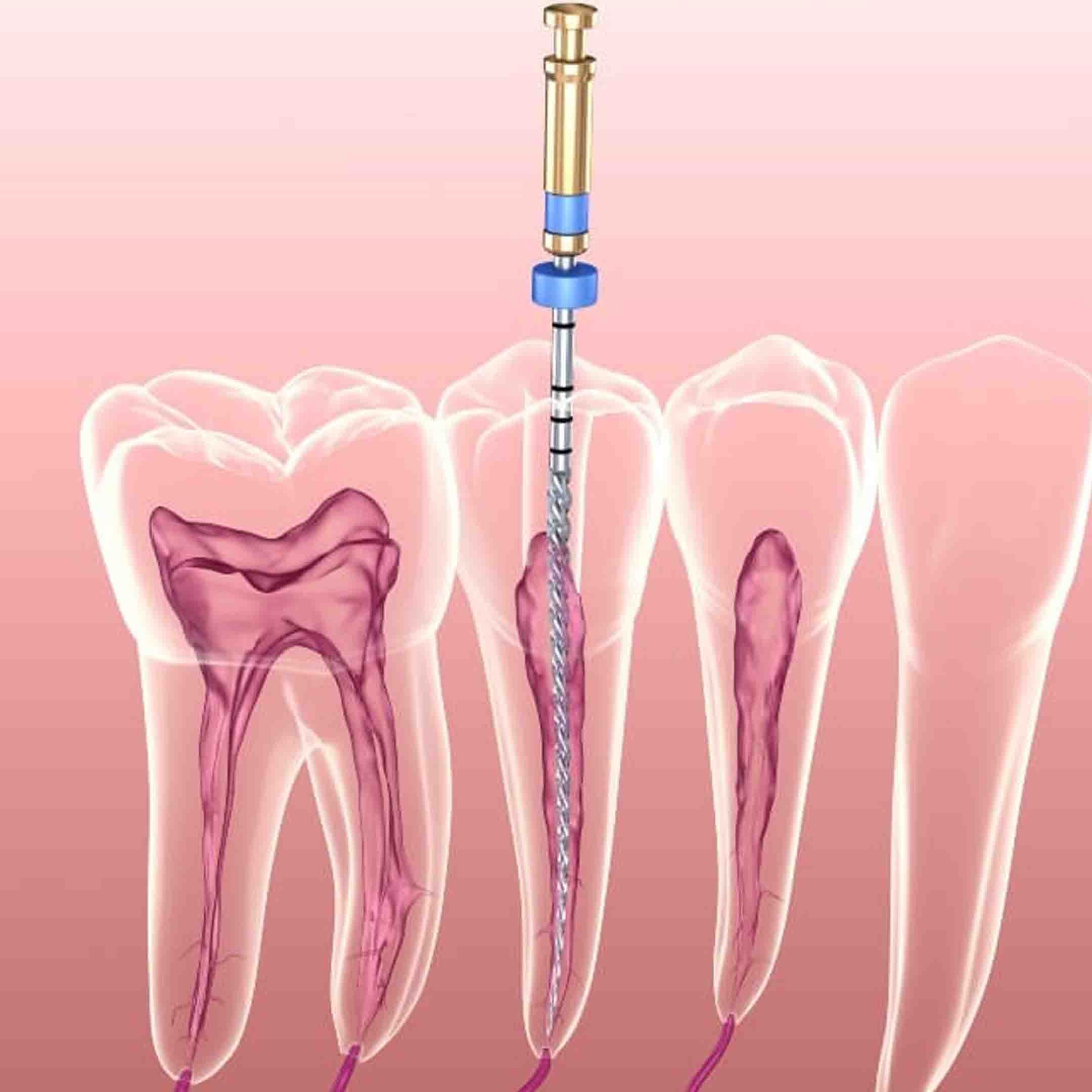 Root Canal Diagram