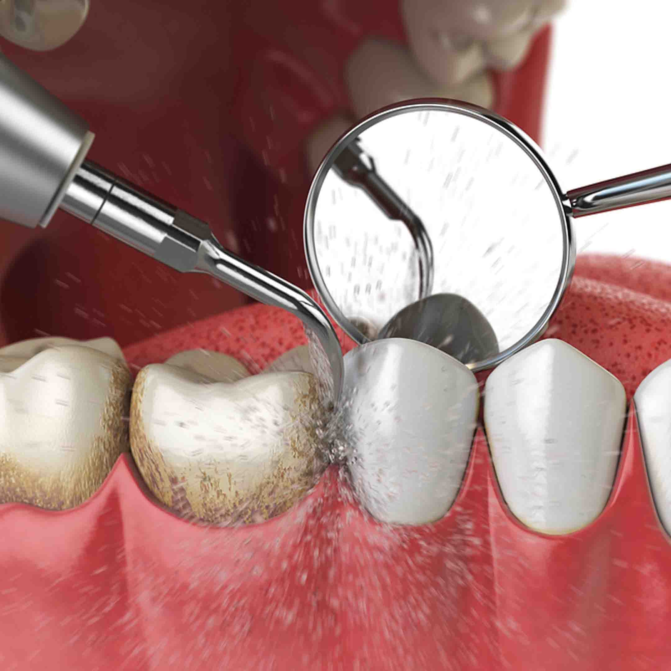 scaling and root planing dental procedure)