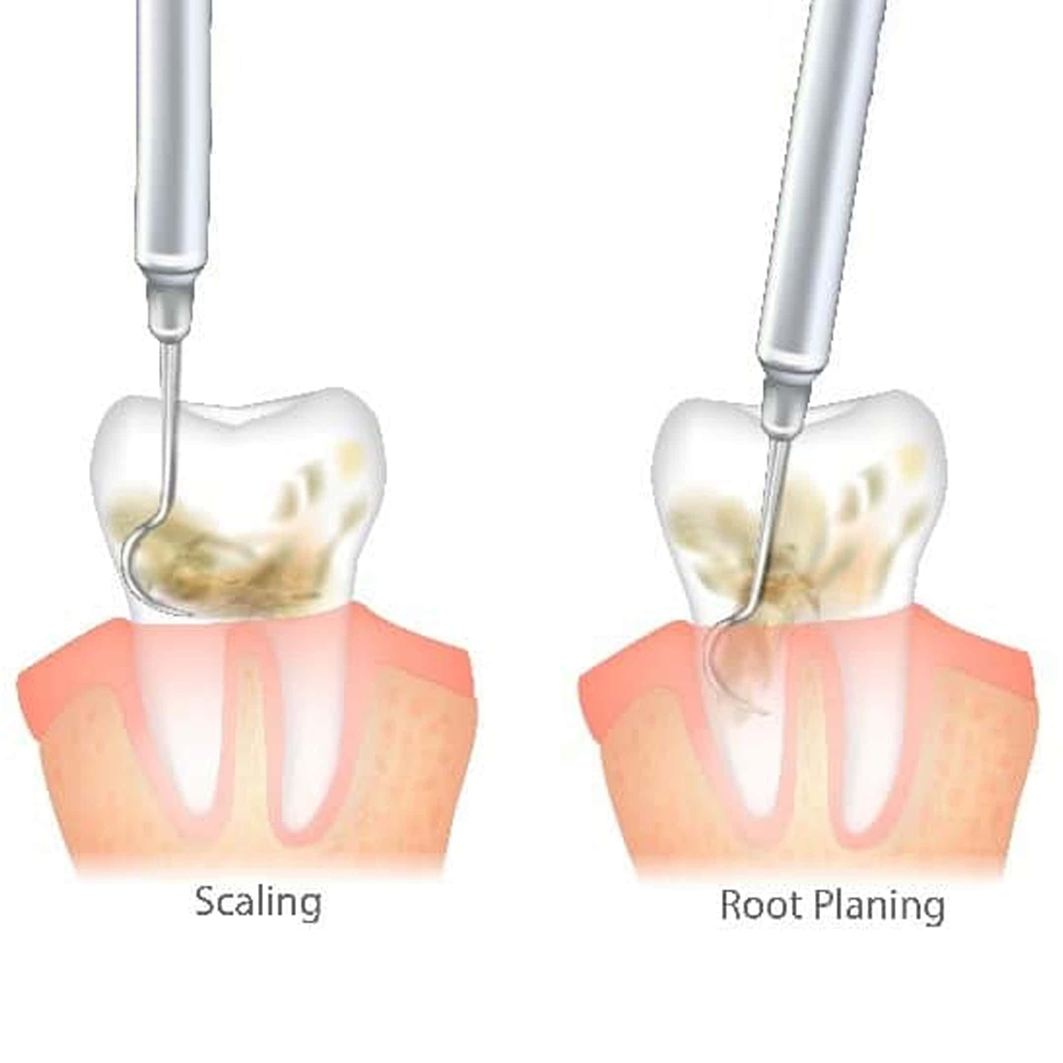 scaling vs root planing