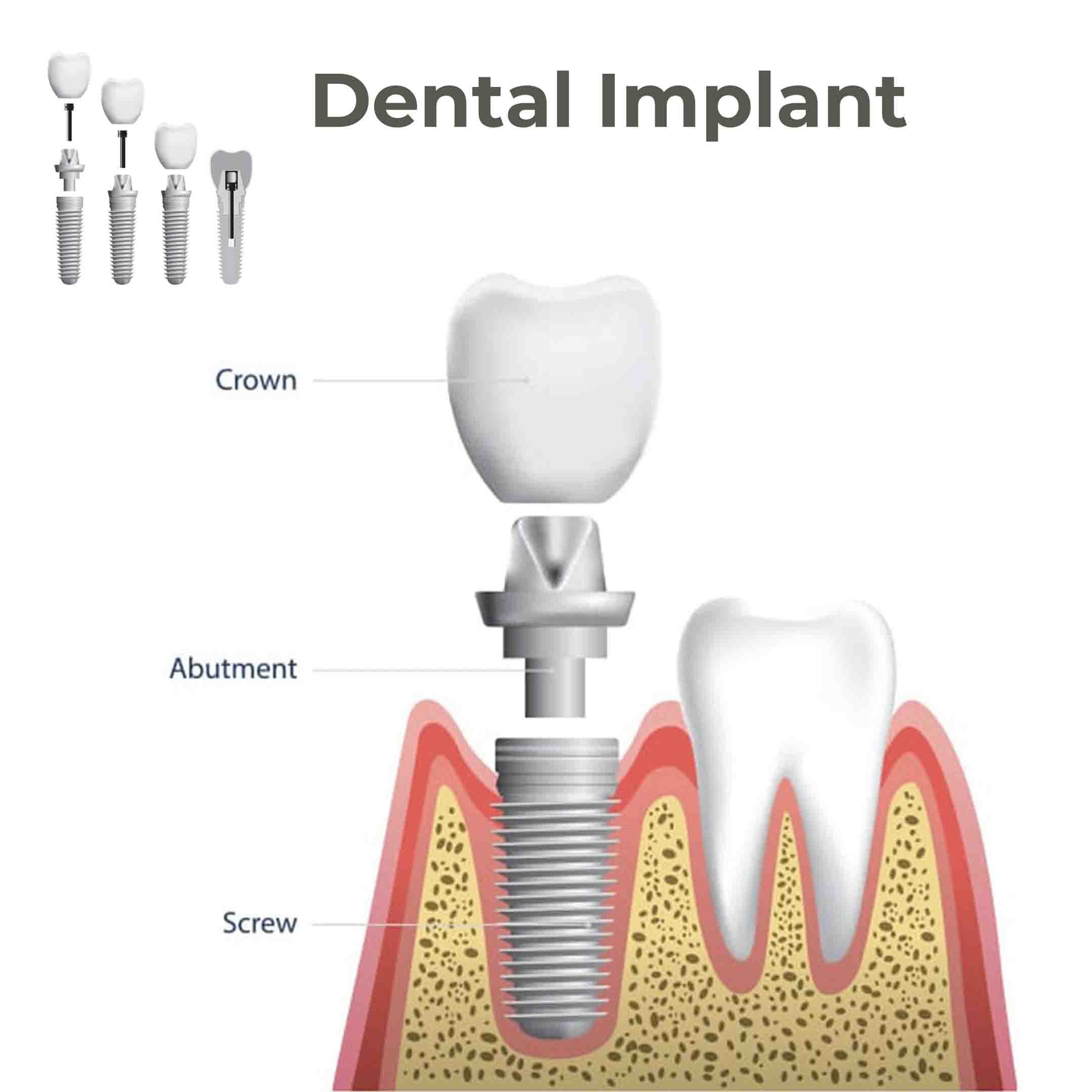 step by step dental implant procedure photos