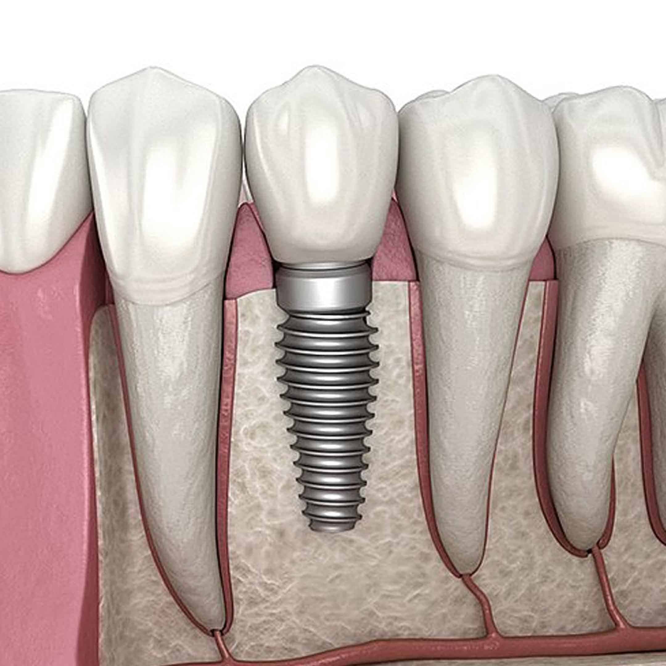 dental implants fresno ca