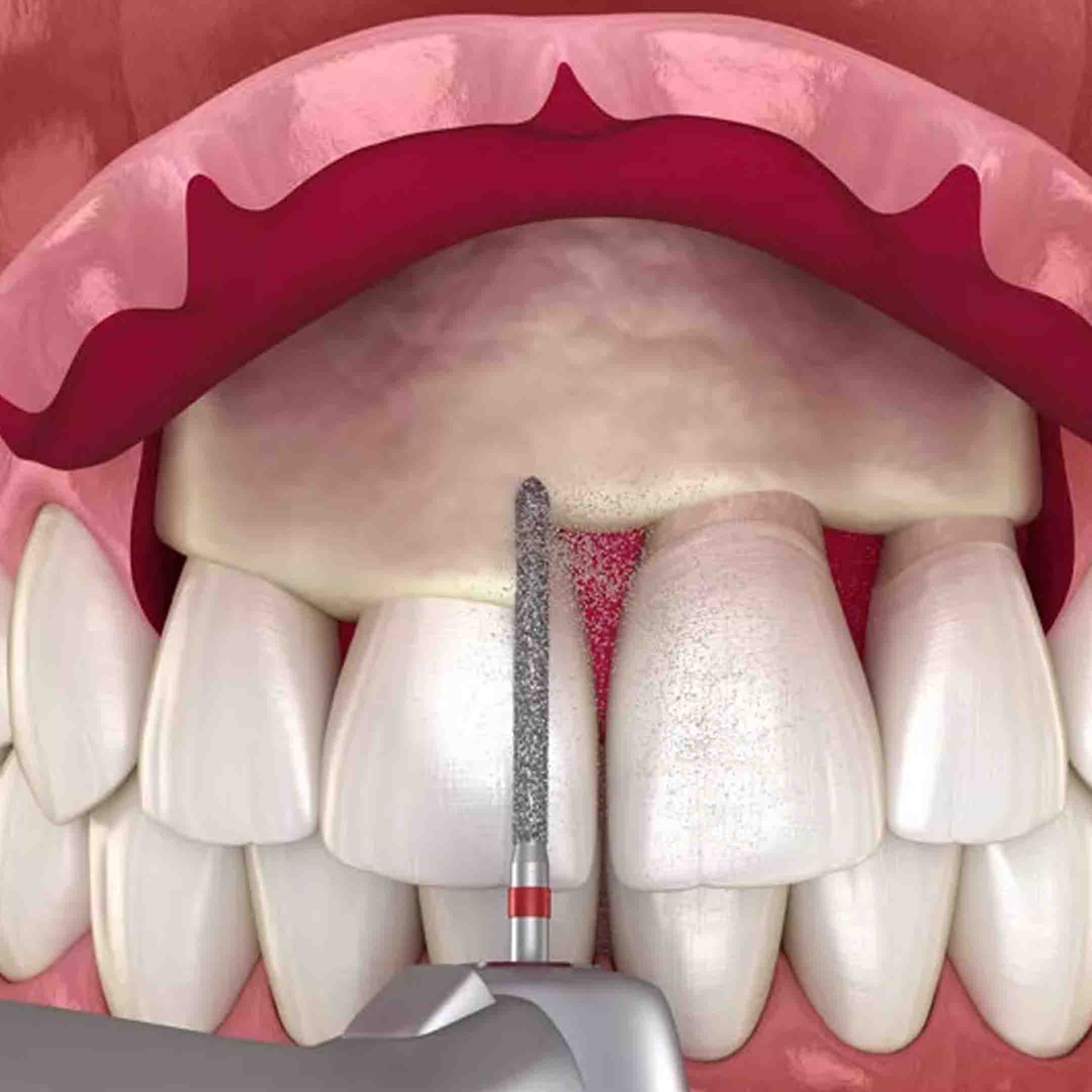 What is Gummy Smile Surgery?