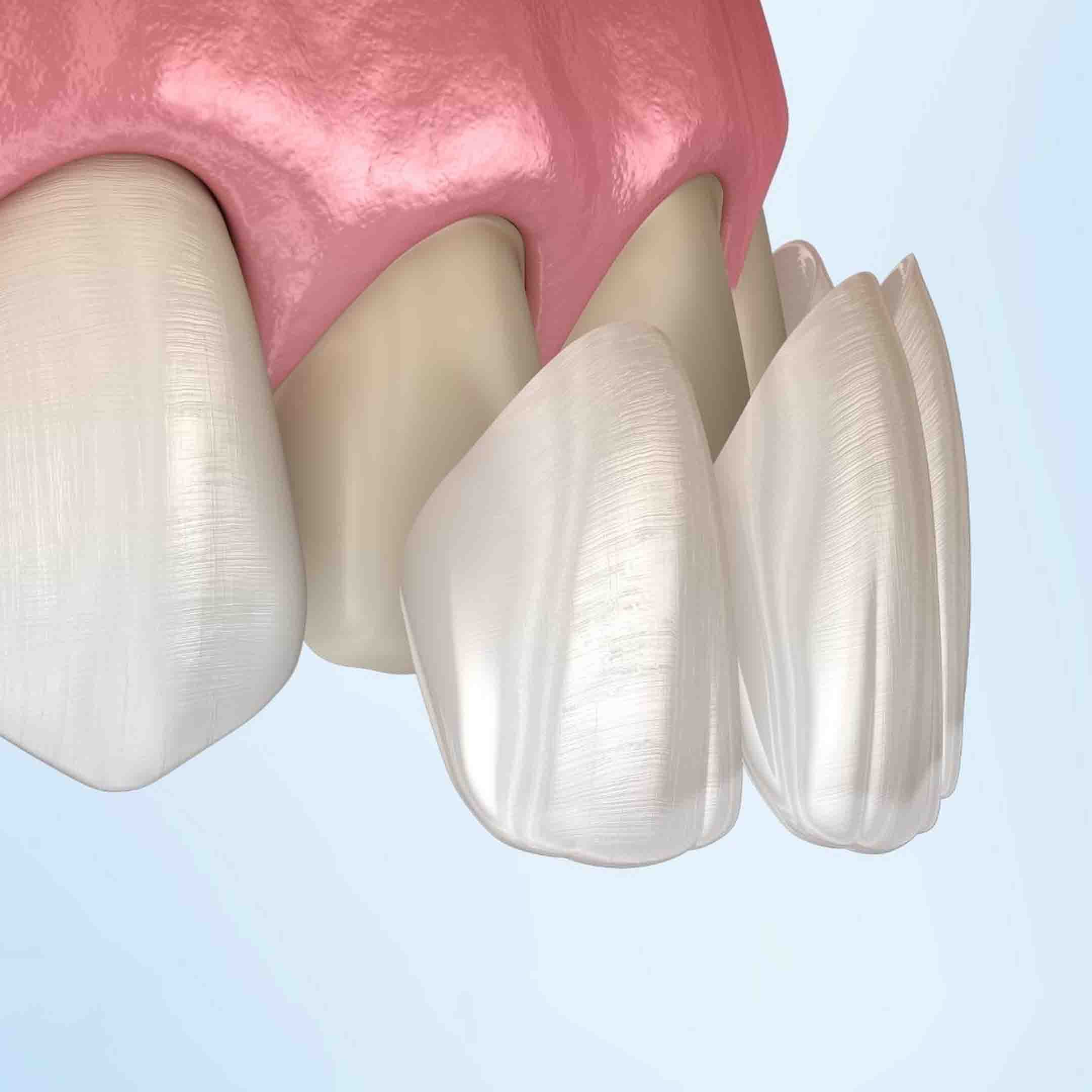 what is dental veneers