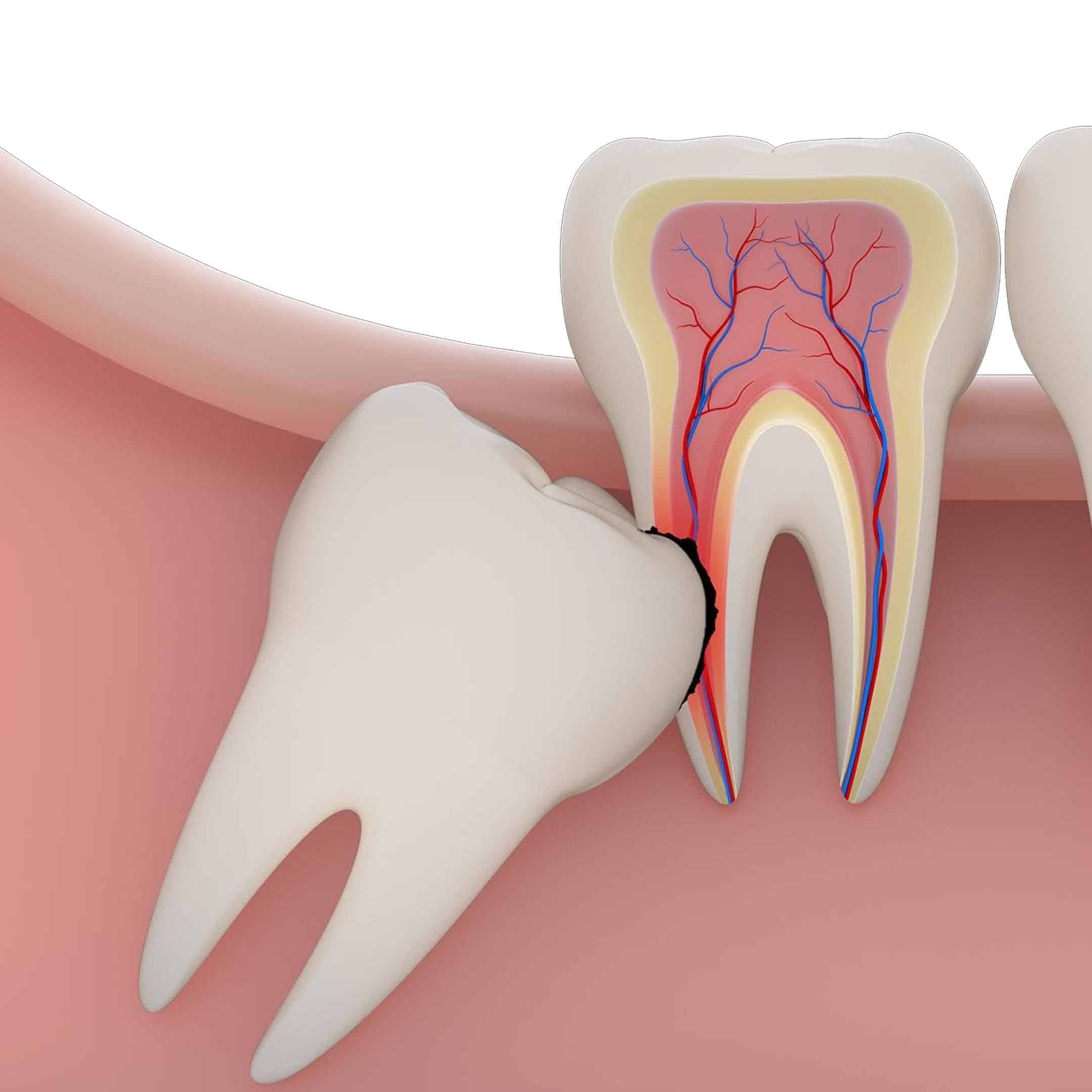 wisdom teeth fresno ca